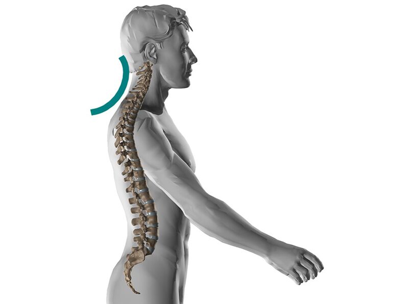 Osteocondrose cervical da columna, causando moitos síntomas desagradables