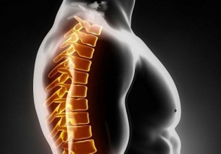 A osteocondrose torácica acompaña a dor e molestias no medio das costas