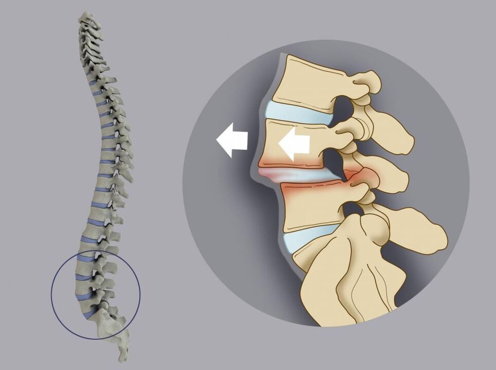a desalineación vertebral como causa de dor lumbar
