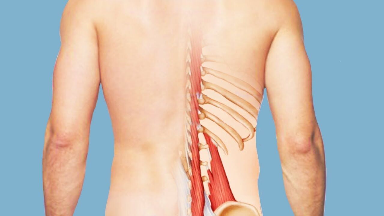 miosite como causa de dor lumbar