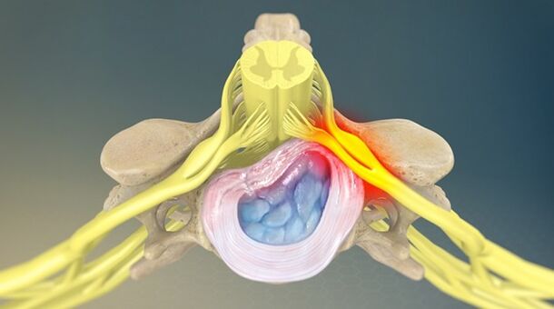 síndrome radicular como causa de dor lumbar