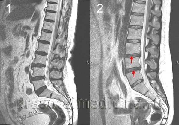 osteocondrose espinal